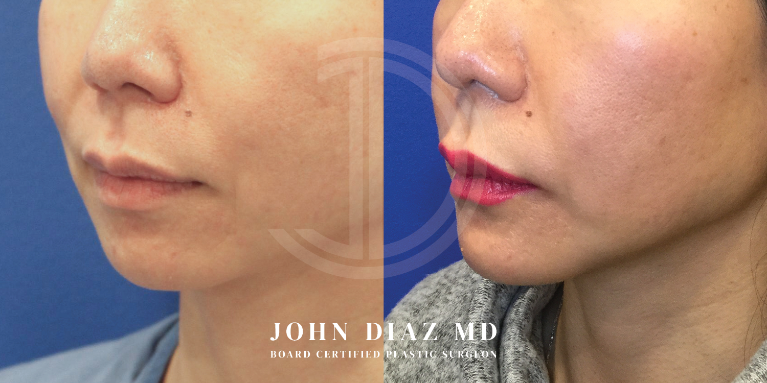 Dr John Diaz Chin Augmentation Before and After | Patient 14