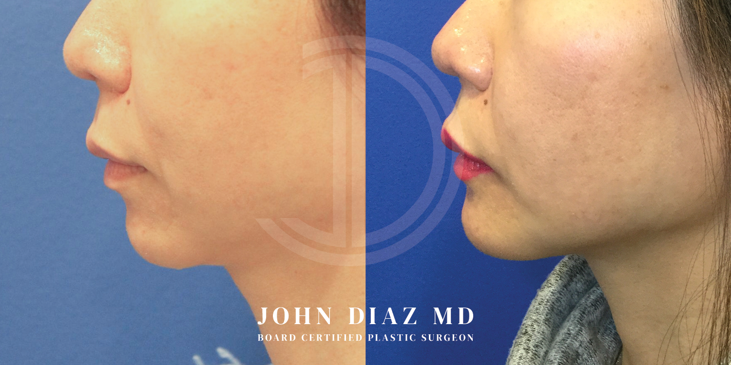 Dr John Diaz Chin Augmentation Before and After | Patient 14