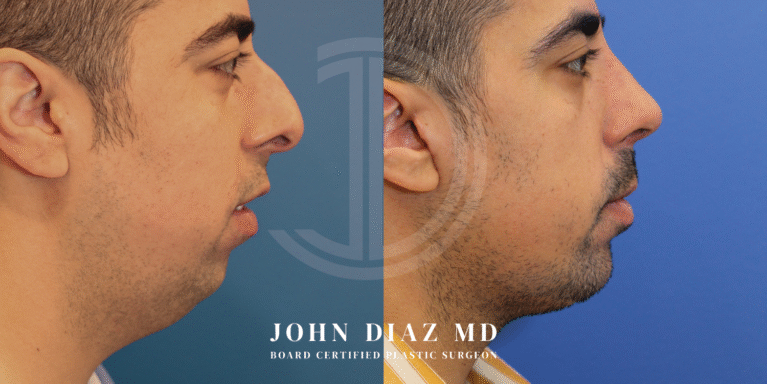 Dr John Diaz Before and After | Chin Augmentation, Rhinoplasty