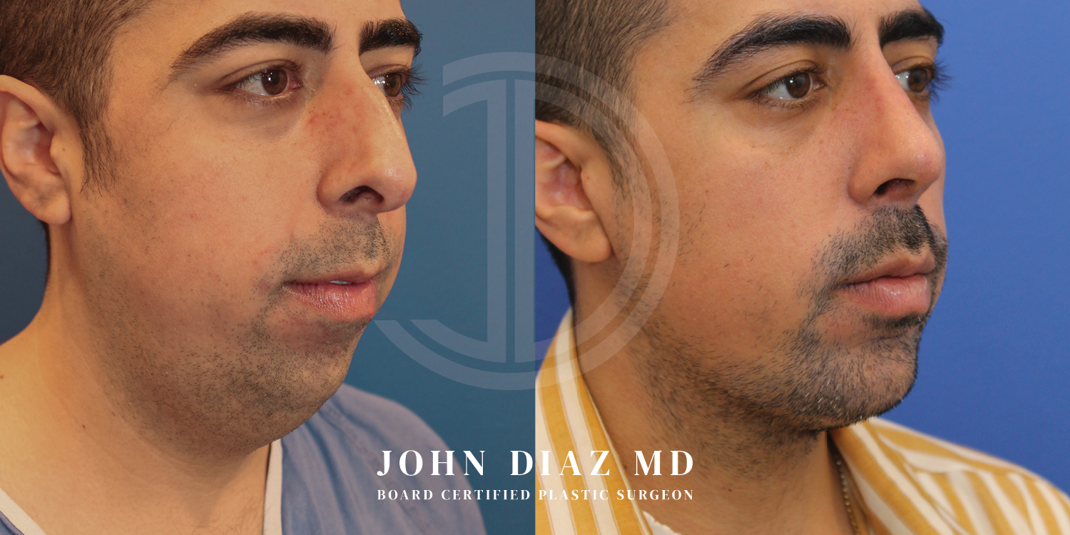 Dr John Diaz Before and After | Chin Augmentation, Rhinoplasty