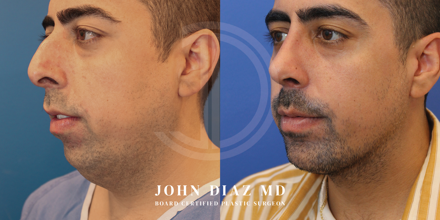 Dr John Diaz Before and After | Chin Augmentation, Rhinoplasty