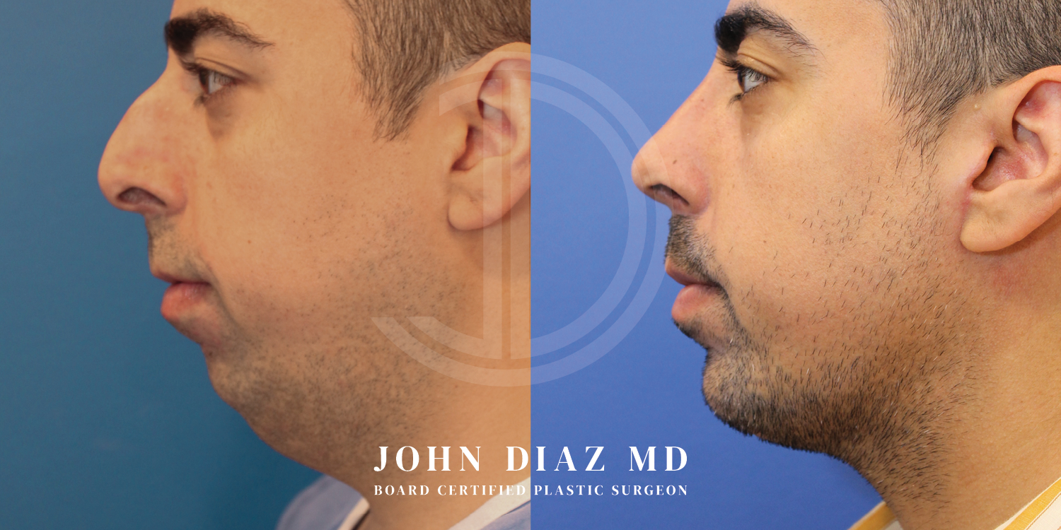 Dr John Diaz Before and After | Chin Augmentation, Rhinoplasty