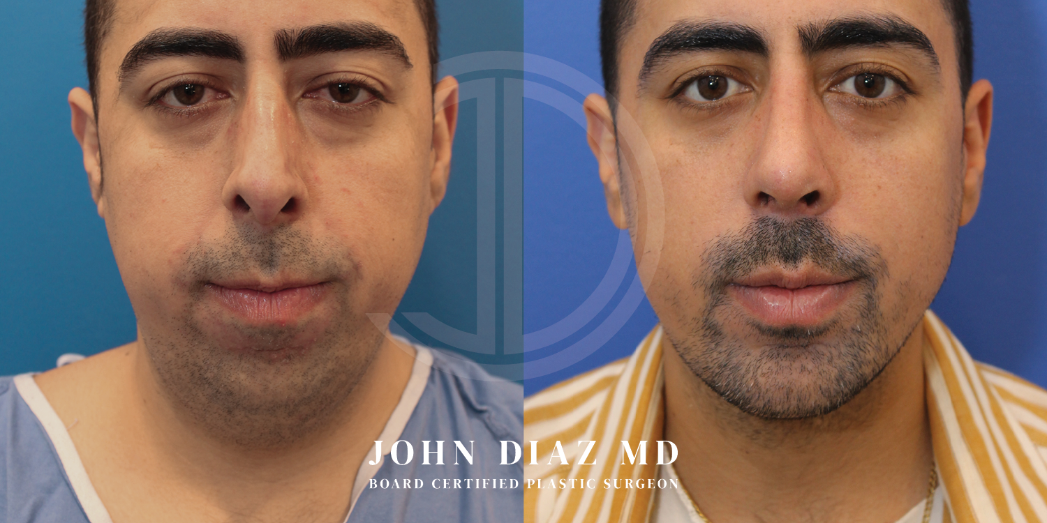 Dr John Diaz Before and After | Chin Augmentation, Rhinoplasty