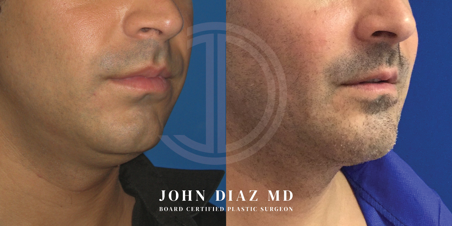 Dr John Diaz Chin Augmentation Before and After | Patient 4