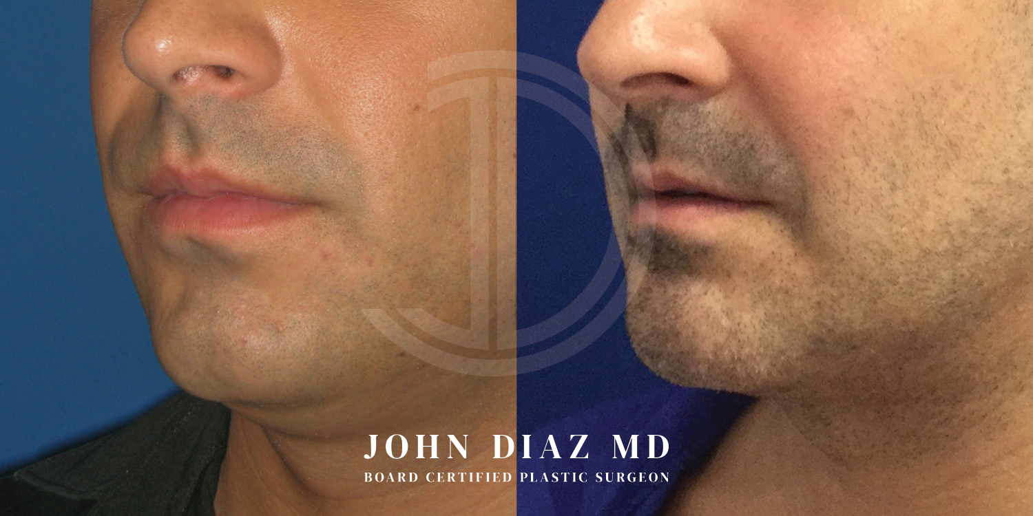 Dr John Diaz Chin Augmentation Before and After | Patient 4