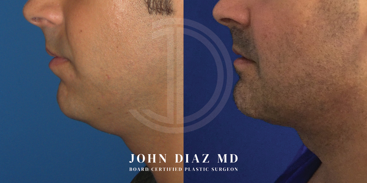 Dr John Diaz Chin Augmentation Before and After | Patient 4