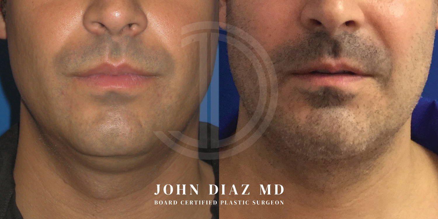 Dr John Diaz Chin Augmentation Before and After | Patient 4
