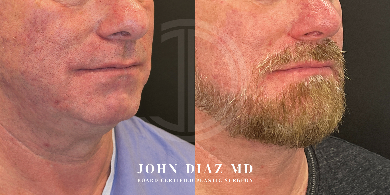 Dr John Diaz Chin Augmentation Before and After | Patient 5