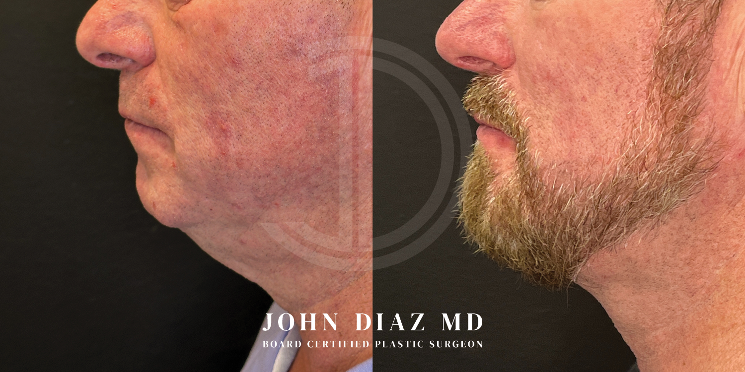 Dr John Diaz Chin Augmentation Before and After | Patient 5