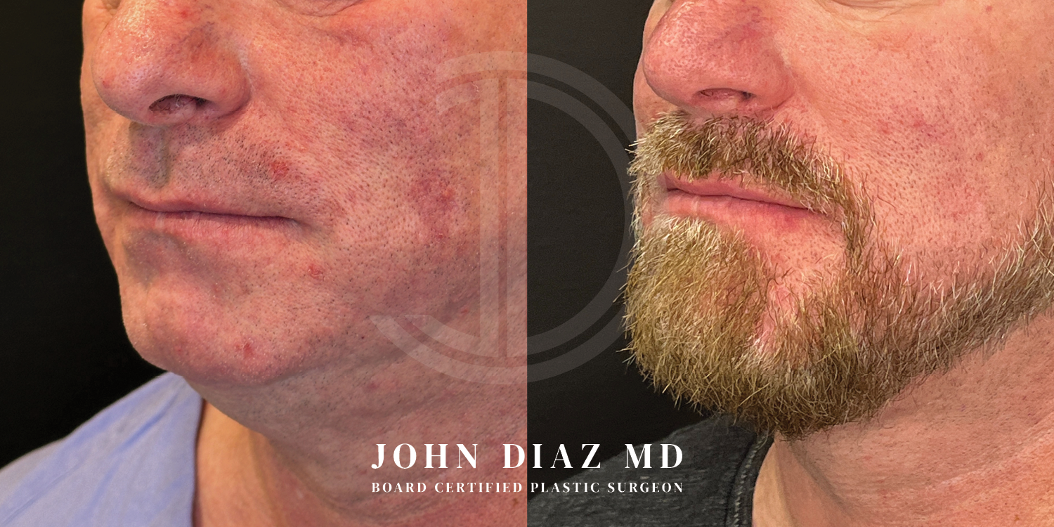 Dr John Diaz Chin Augmentation Before and After | Patient 5