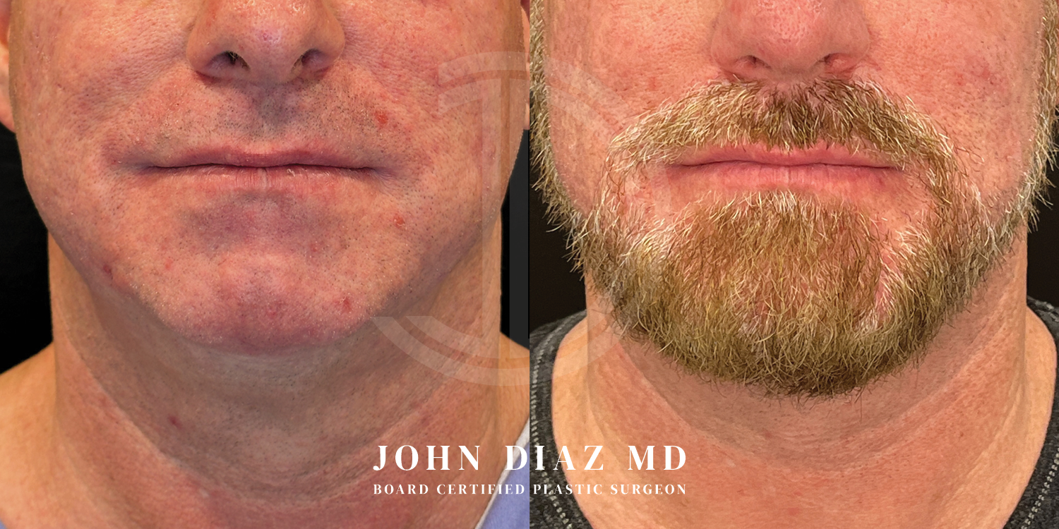 Dr John Diaz Chin Augmentation Before and After | Patient 5