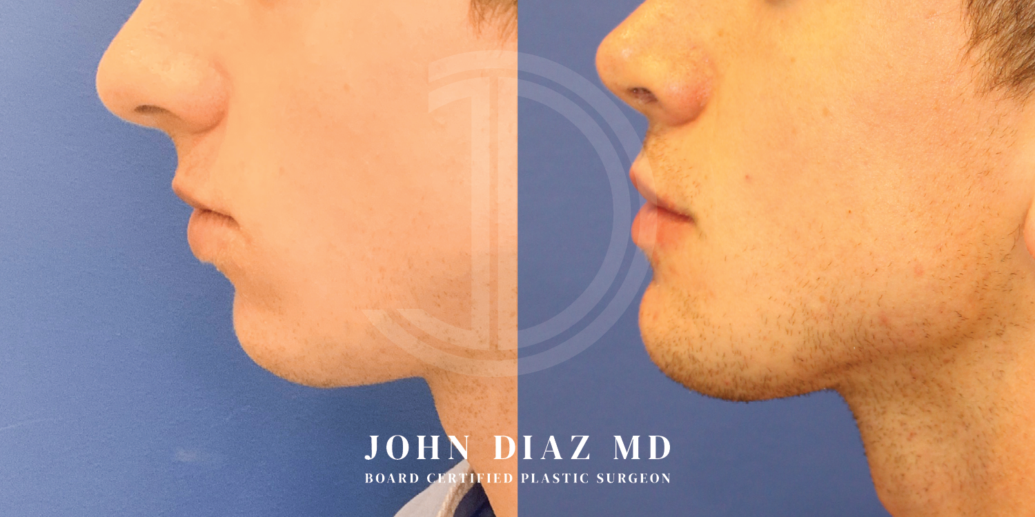 Dr John Diaz Chin Augmentation Before and After | Patient 6