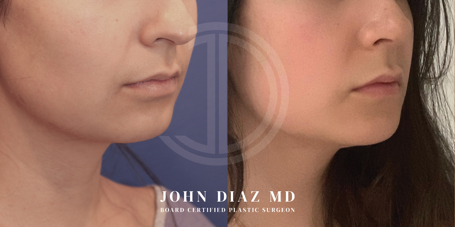 Dr John Diaz Chin Augmentation Before and After | Patient 7