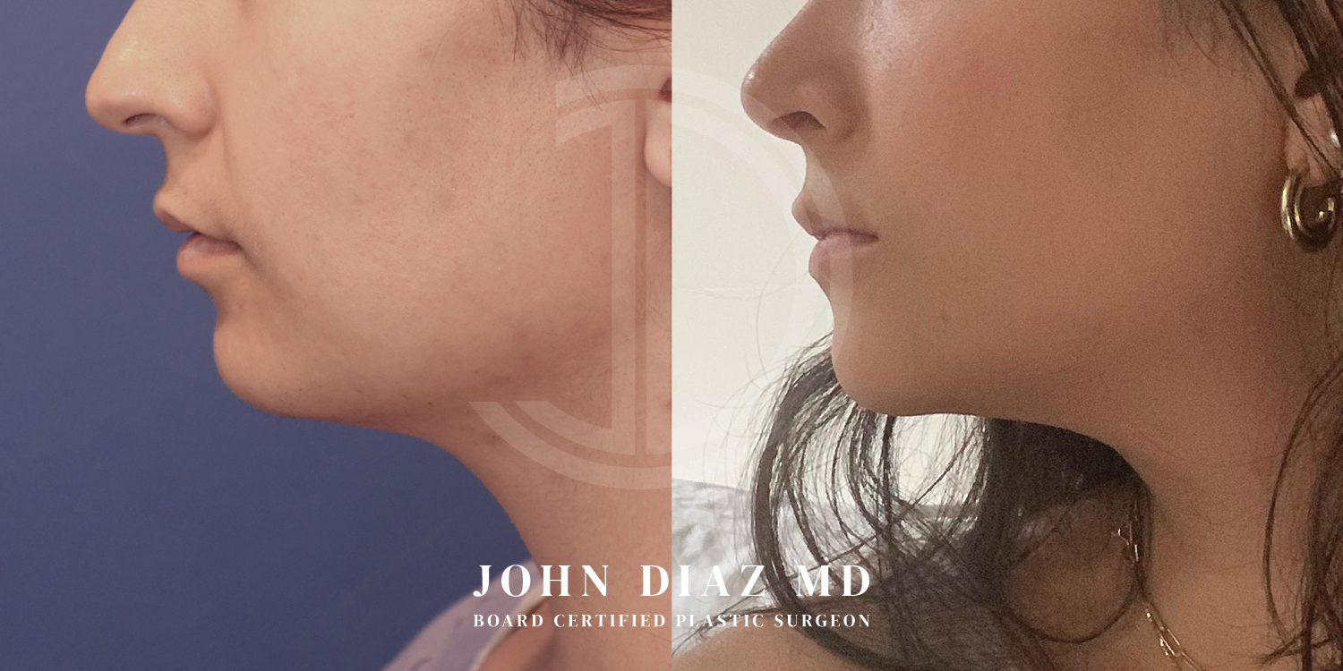 Dr John Diaz Chin Augmentation Before and After | Patient 7