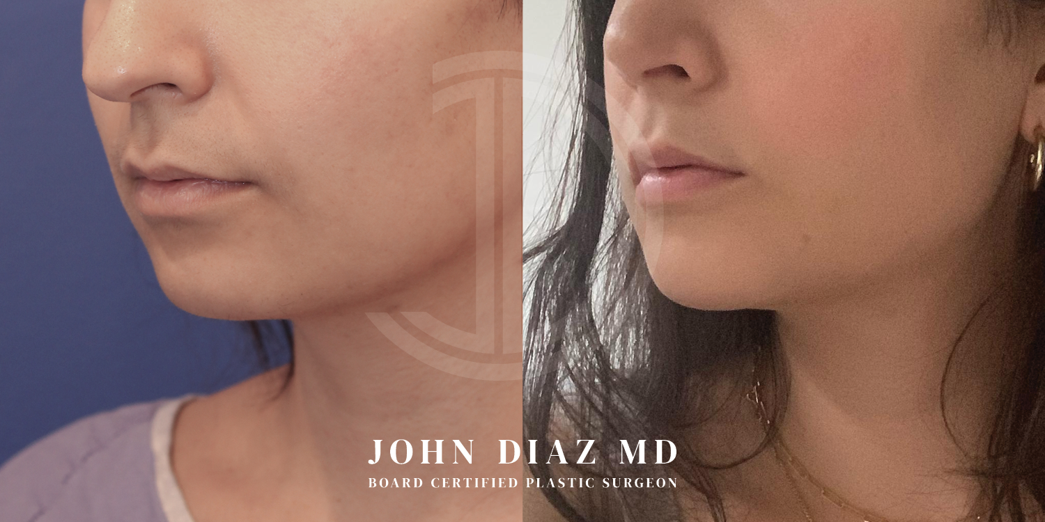 Dr John Diaz Chin Augmentation Before and After | Patient 7