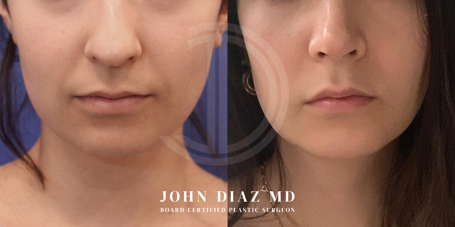 Dr John Diaz Chin Augmentation Before and After | Patient 7