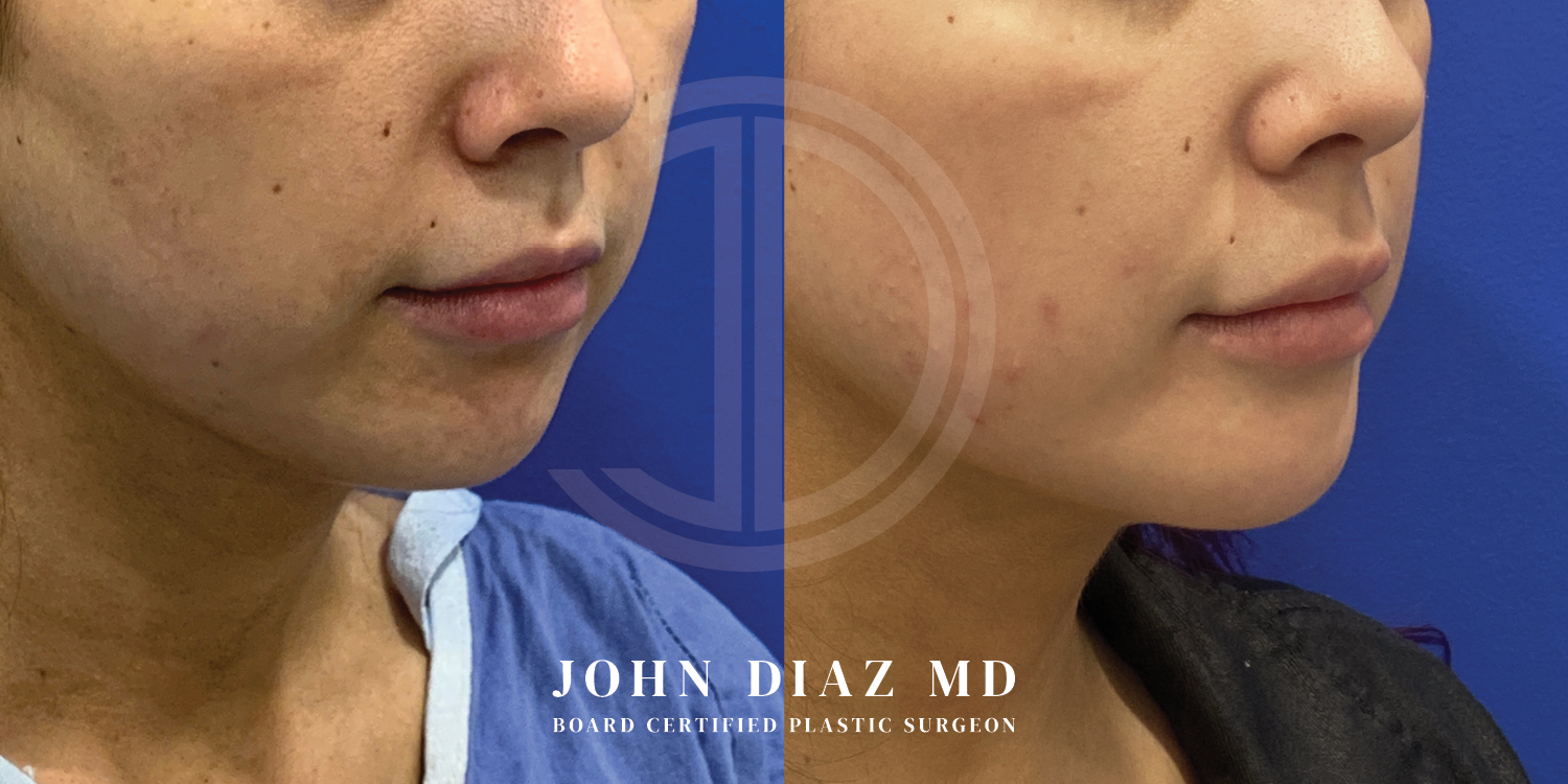Dr John Diaz Chin Augmentation Before and After | Patient 8