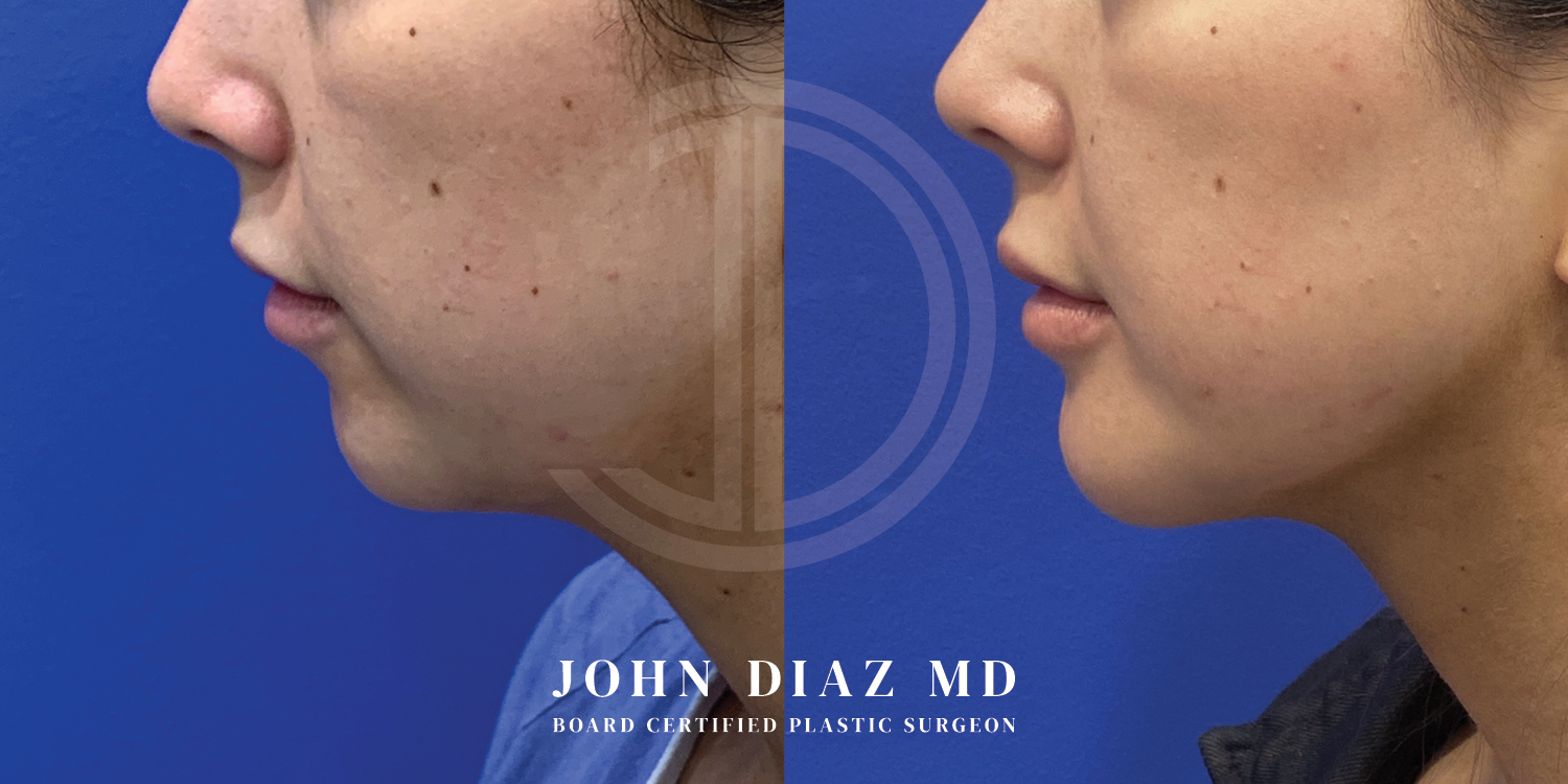Dr John Diaz Chin Augmentation Before and After | Patient 8