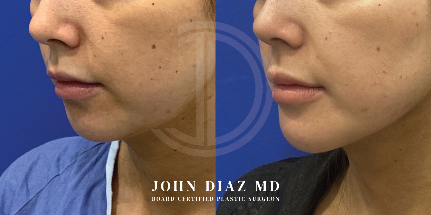 Dr John Diaz Chin Augmentation Before and After | Patient 8