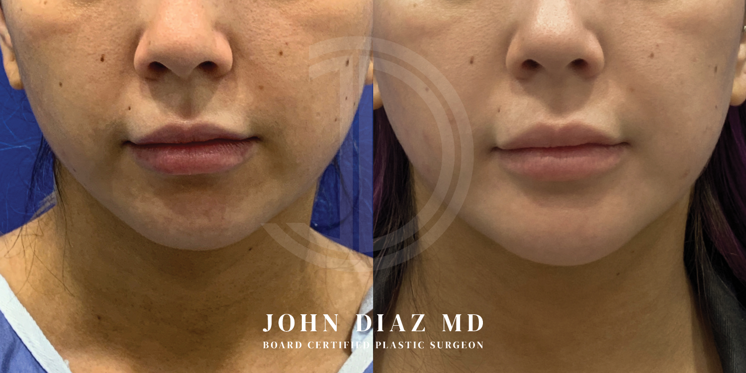 Dr John Diaz Chin Augmentation Before and After | Patient 8