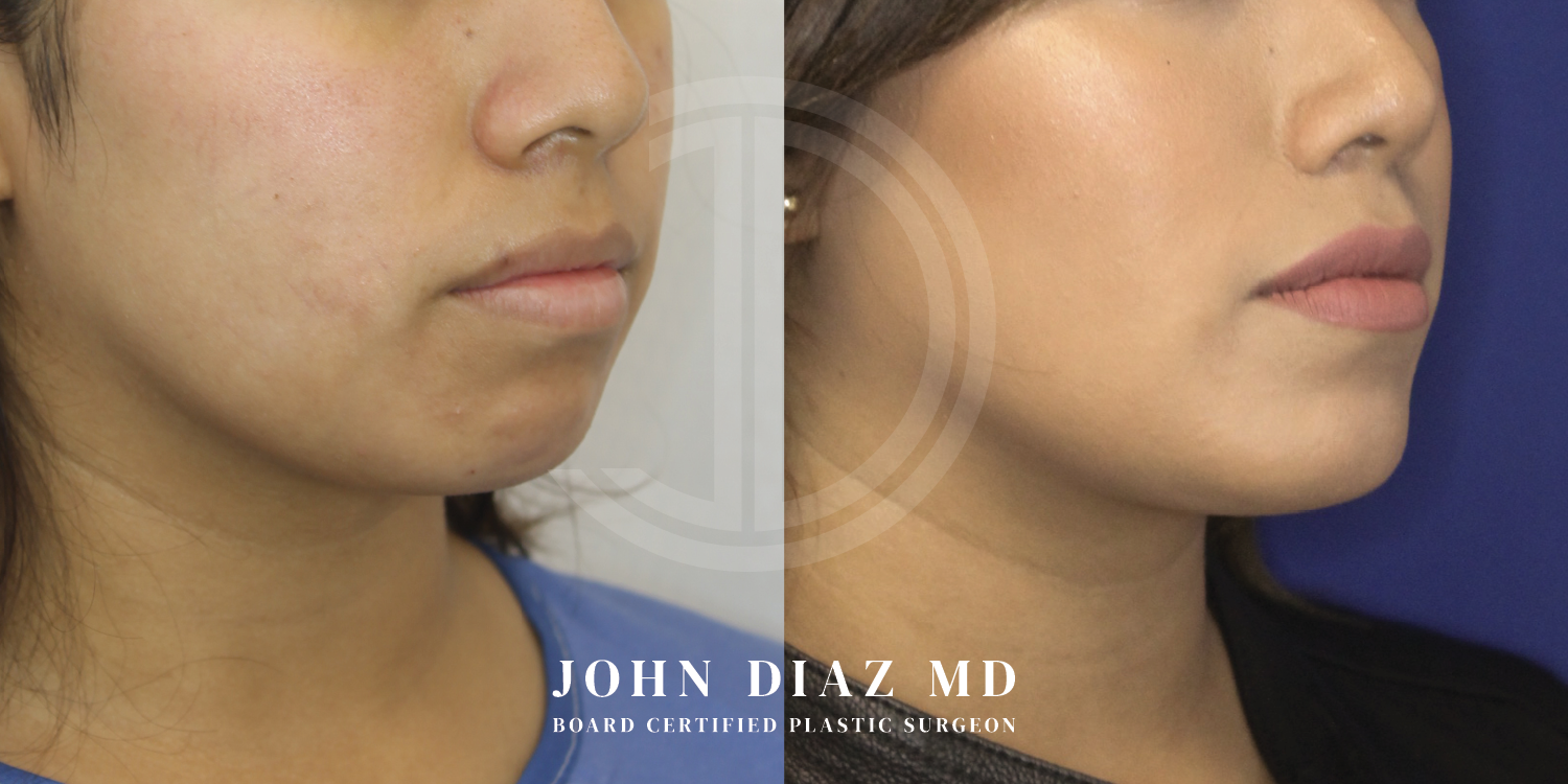 Dr John Diaz Chin Augmentation Before and After | Patient 9