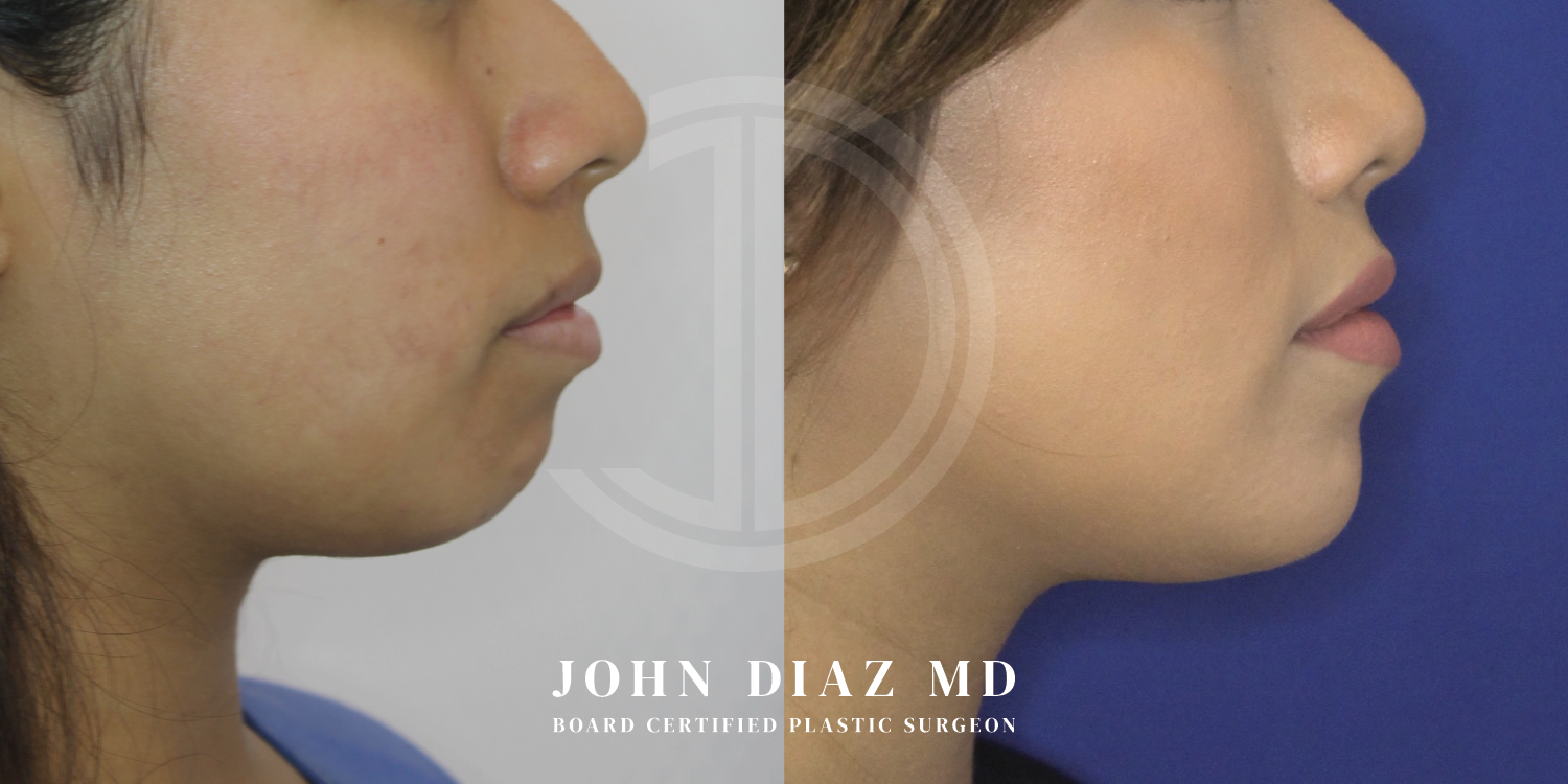 Dr John Diaz Chin Augmentation Before and After | Patient 9