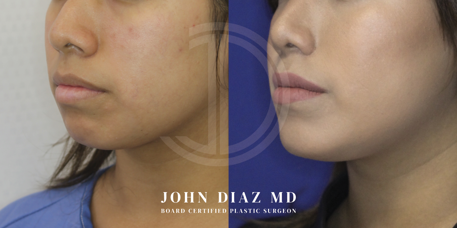 Dr John Diaz Chin Augmentation Before and After | Patient 9