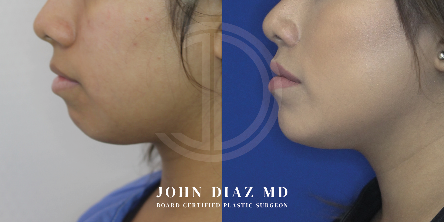 Dr John Diaz Chin Augmentation Before and After | Patient 9