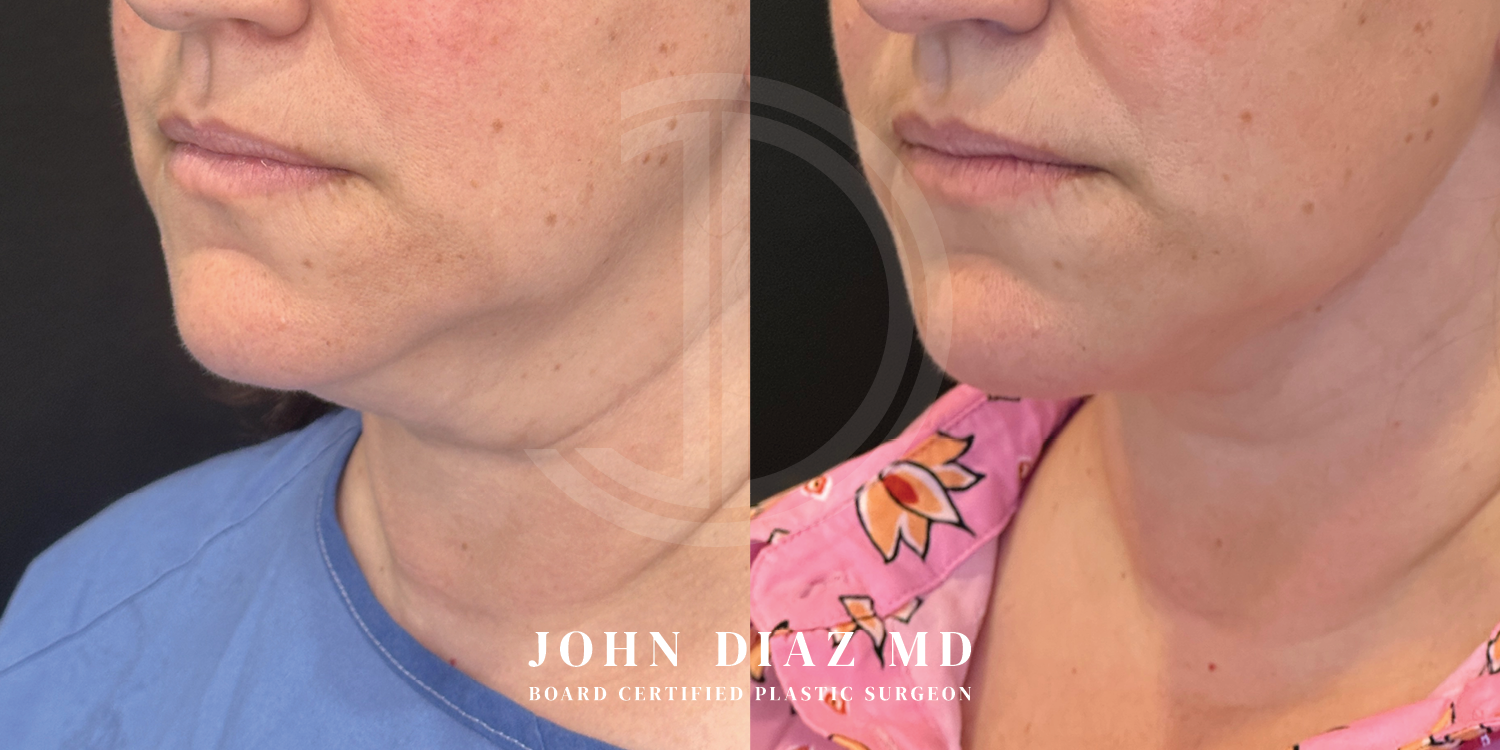 Dr John Diaz Neck Lift Before and After | Patient 10
