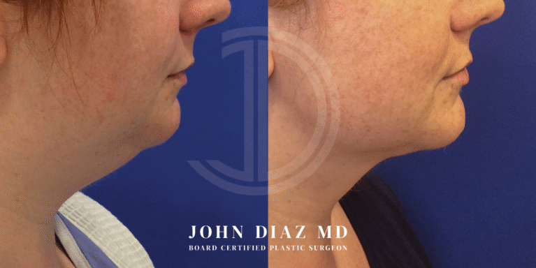 Dr John Diaz Neck Lift Before and After | Patient 11