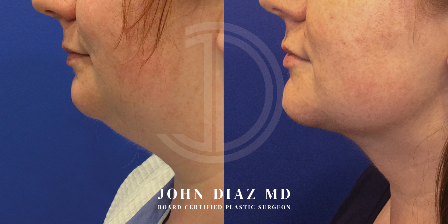 Dr John Diaz Neck Lift Before and After | Patient 11