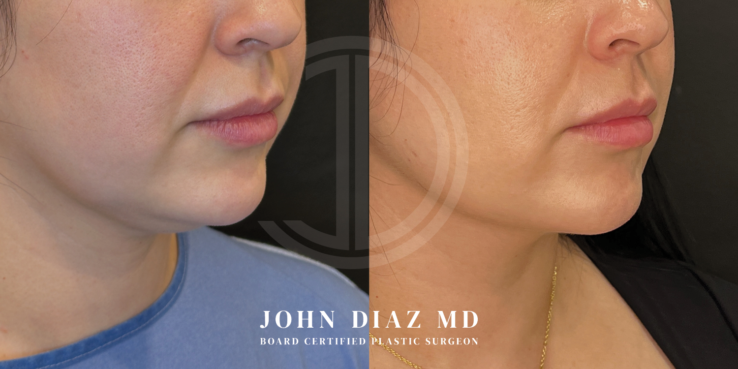 Dr John Diaz Neck Lift Before and After | Patient 12