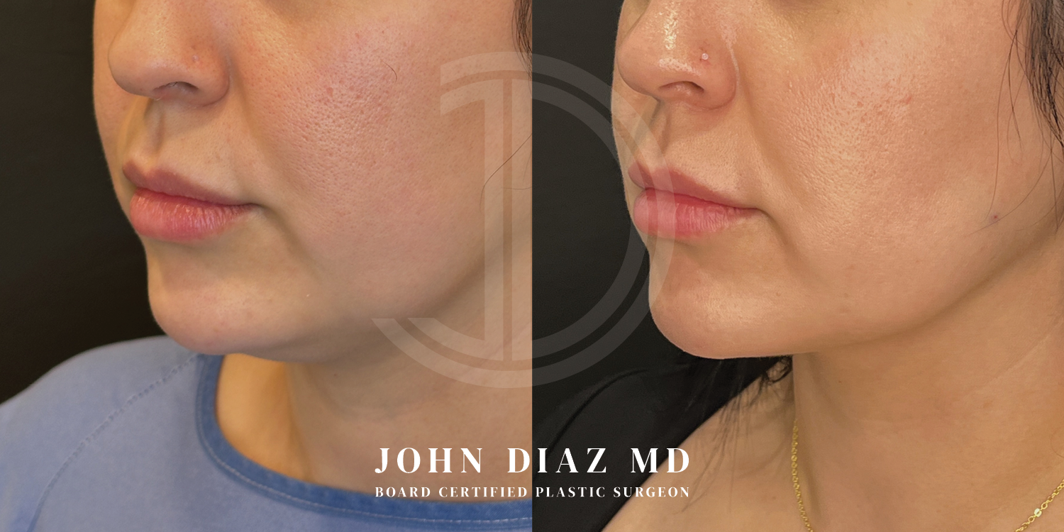 Dr John Diaz Neck Lift Before and After | Patient 12