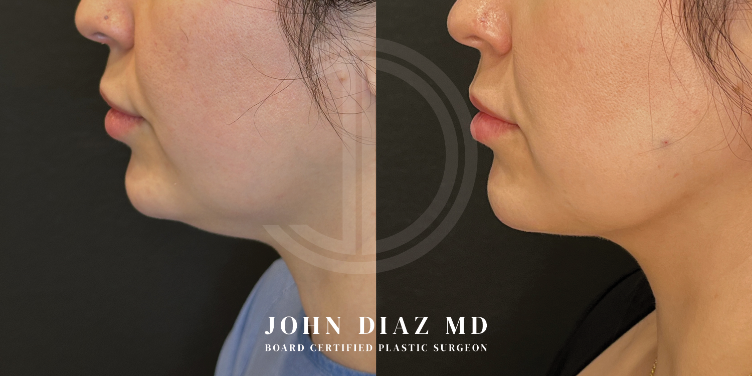 Dr John Diaz Neck Lift Before and After | Patient 12