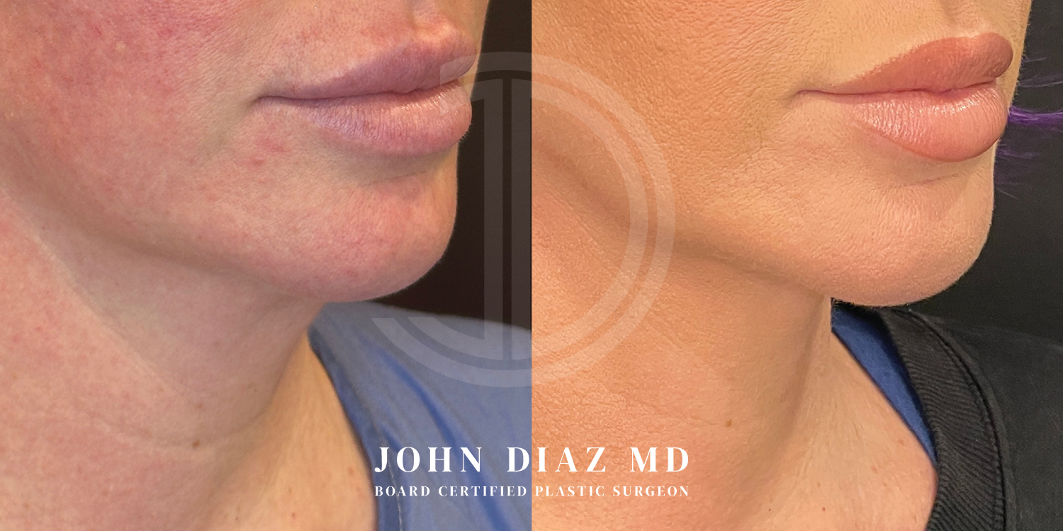 Dr John Diaz Neck Lift Before and After | Patient 13