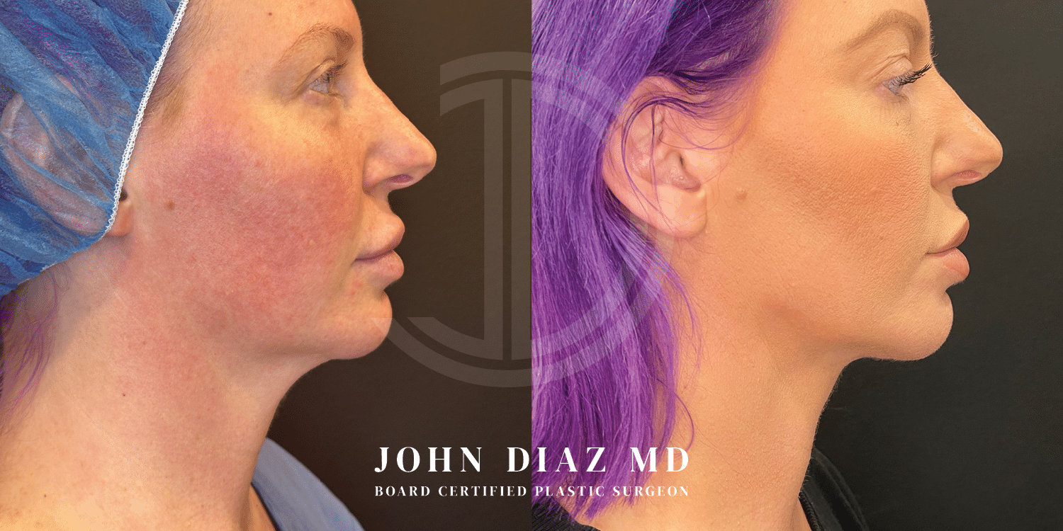 Dr John Diaz neck lift before and after photos of a female patient