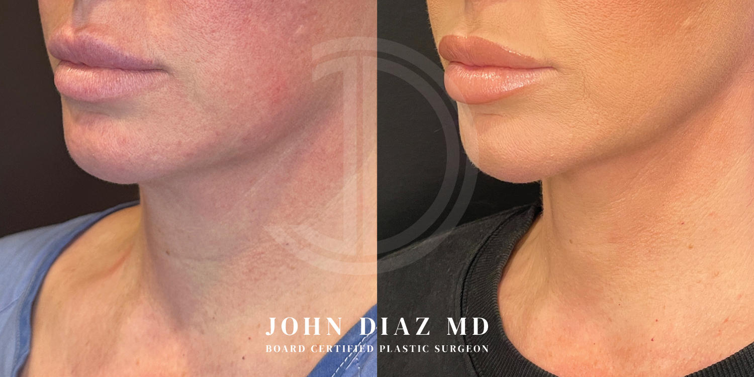 Dr John Diaz Neck Lift Before and After | Patient 13
