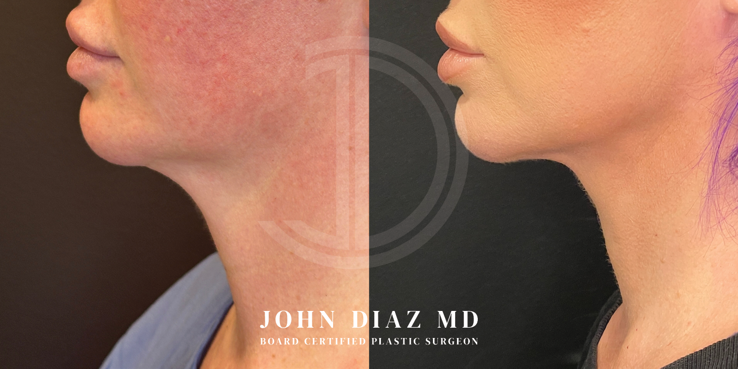 Dr John Diaz Neck Lift Before and After | Patient 13