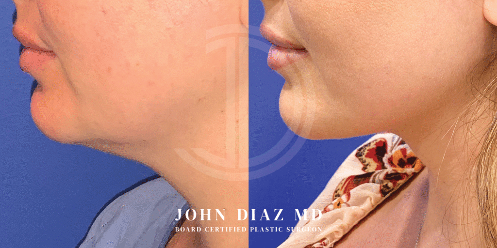 Dr John Diaz Neck Lift Before and After | Patient 14