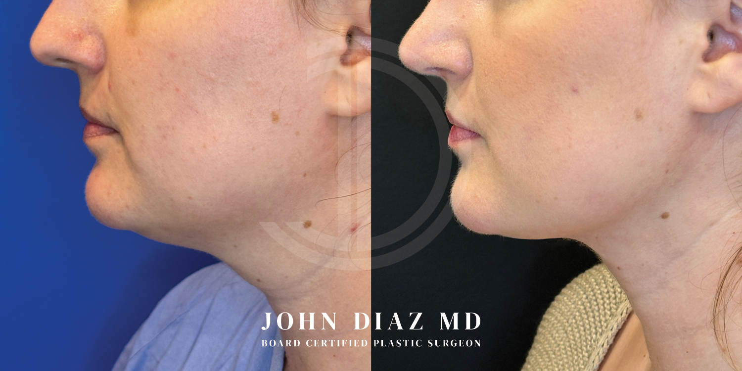 Dr John Diaz Neck Lift Before and After | Patient 15