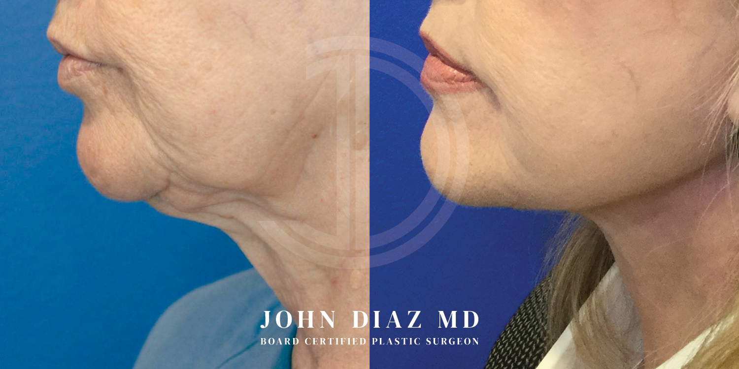 Dr John Diaz Neck Lift Before and After | Patient 1