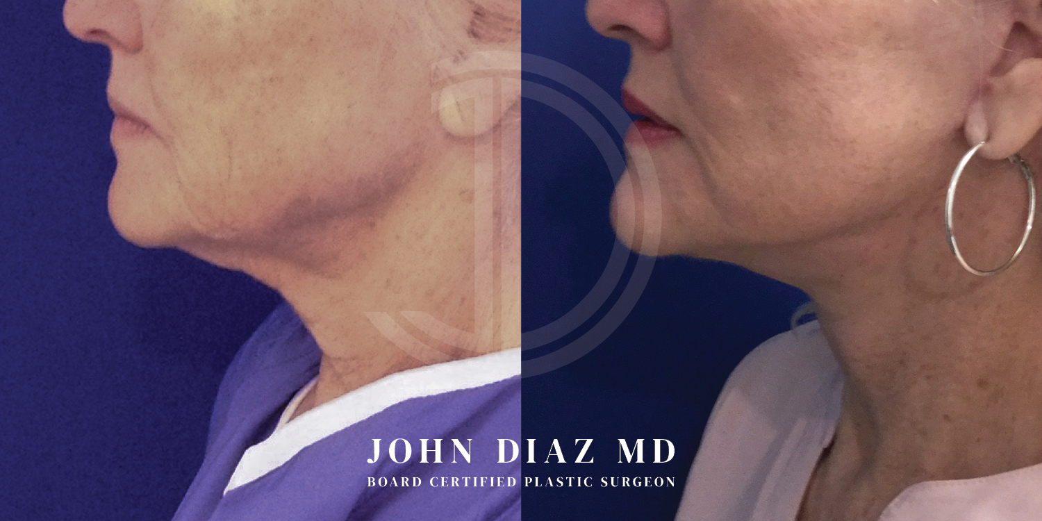 Dr John Diaz Neck Lift Before and After | Patient 2