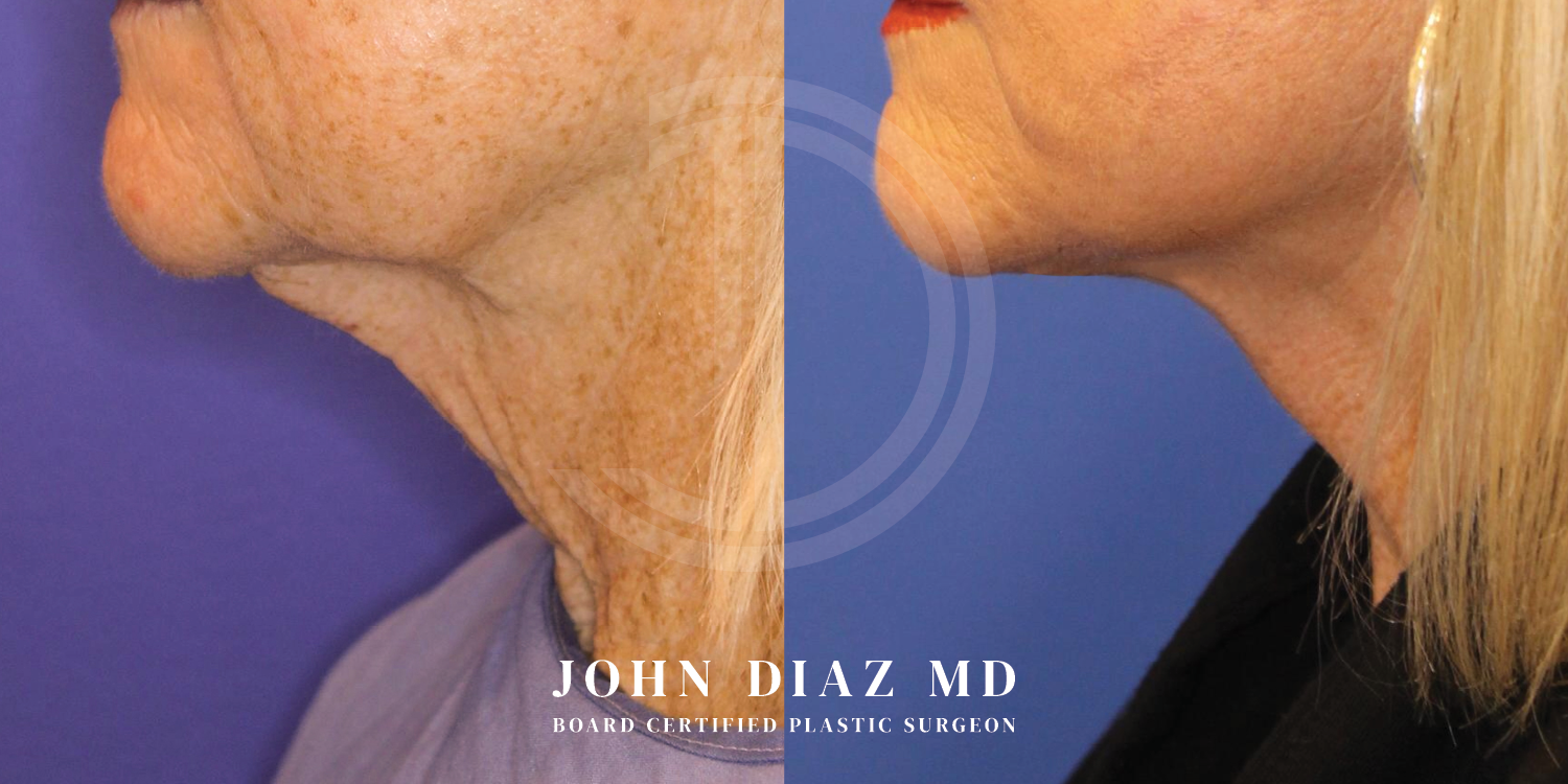 Dr John Diaz Neck Lift Before and After | Patient 3