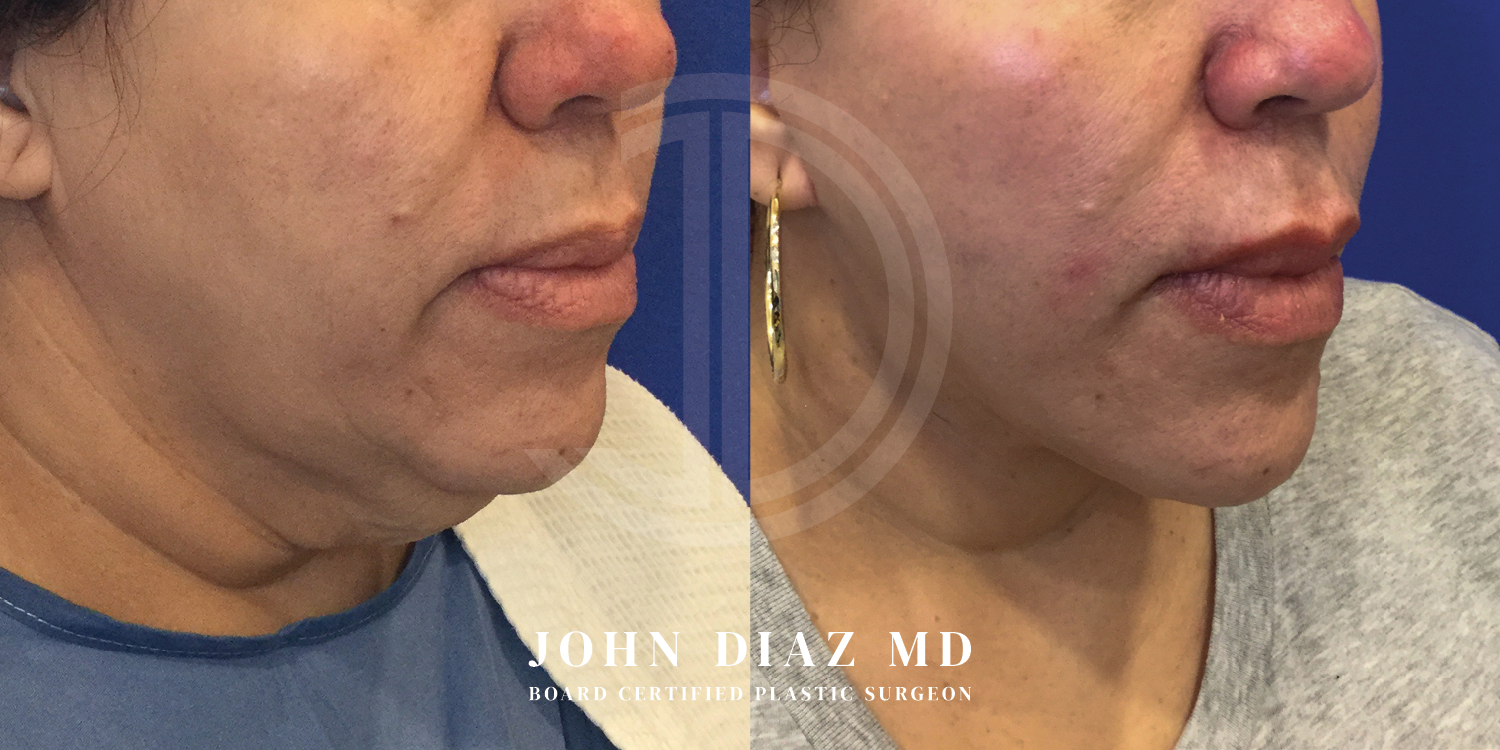 Dr John Diaz Neck Lift Before and After | Patient 4