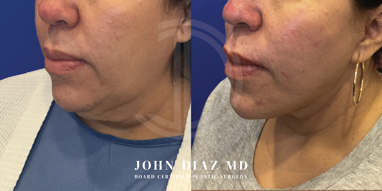 Dr John Diaz Neck Lift Before and After | Patient 4