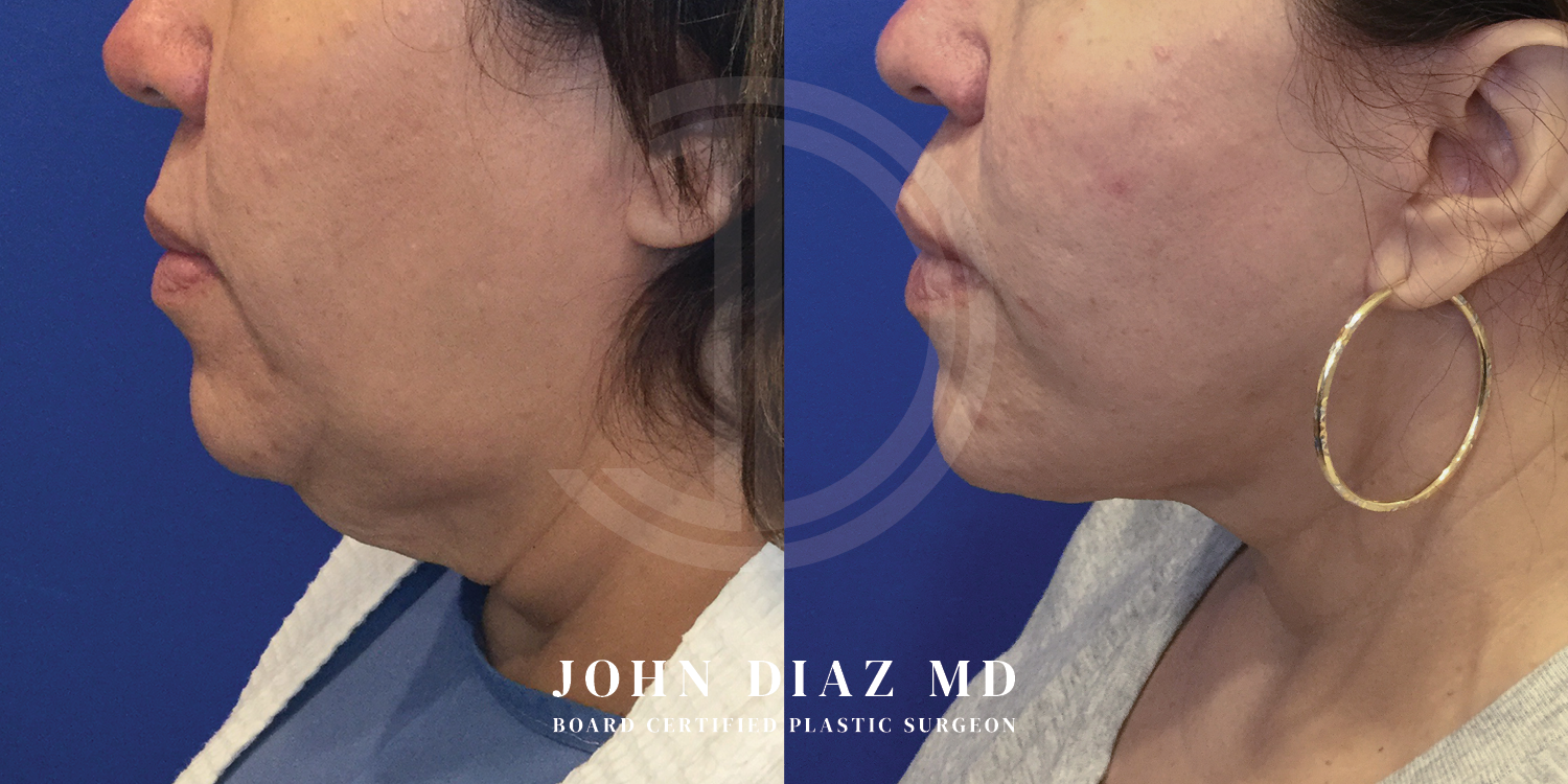 Dr John Diaz Neck Lift Before and After | Patient 4