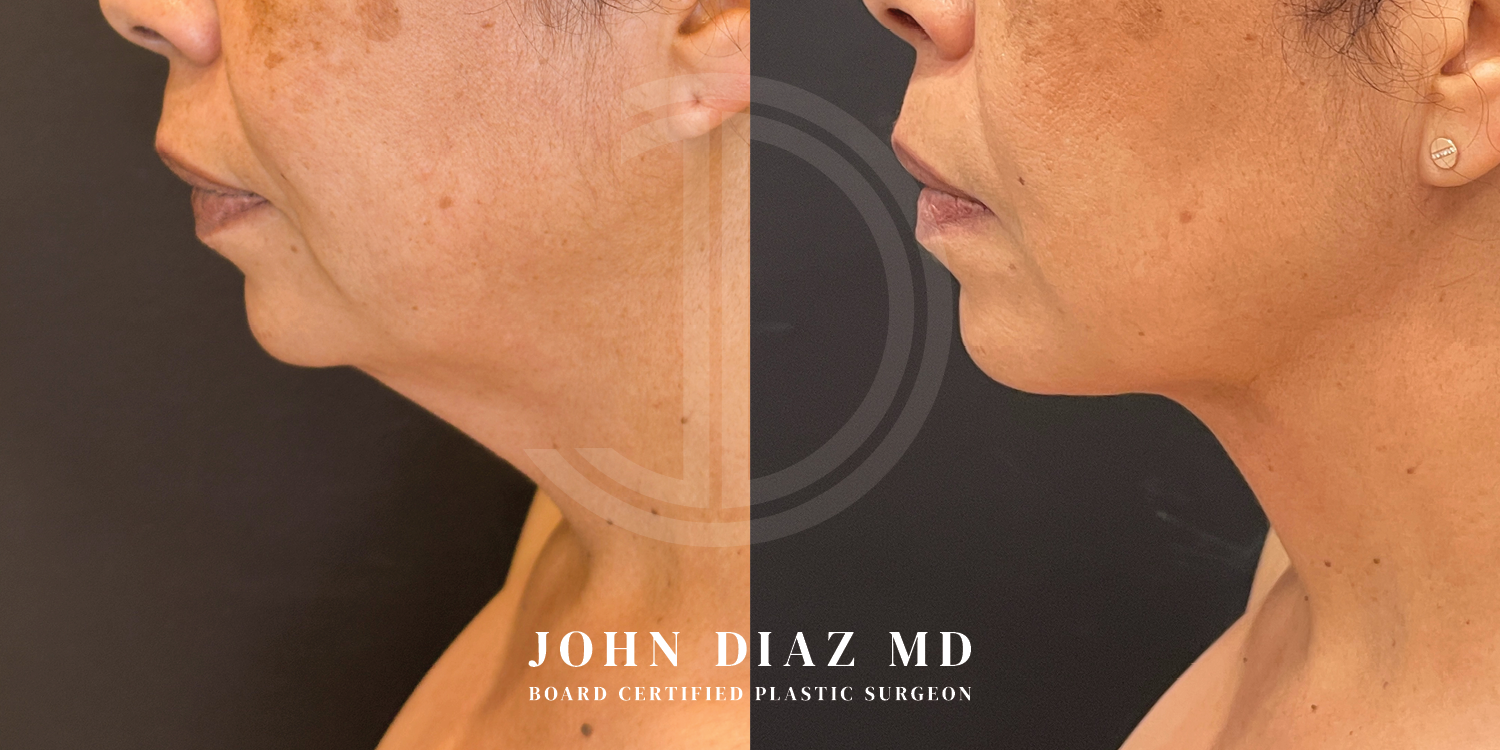 Dr John Diaz Neck Lift Before and After | Patient 5