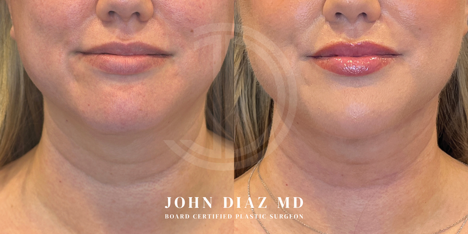 Dr John Diaz Neck Lift Before and After | Patient 6