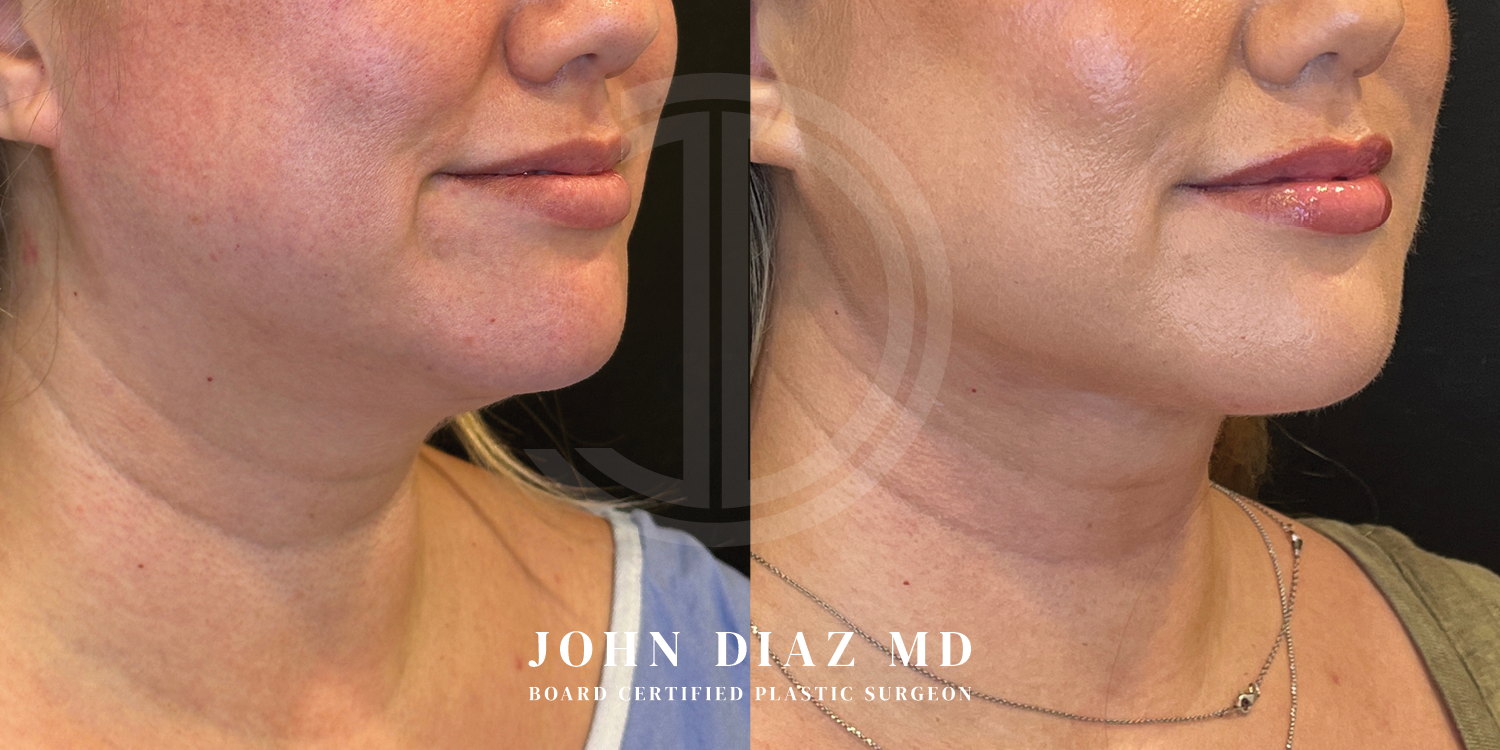 Dr John Diaz Neck Lift Before and After | Patient 6