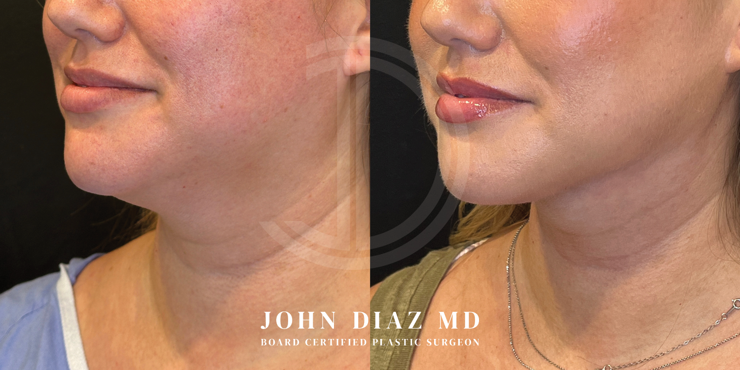 Dr John Diaz Neck Lift Before and After | Patient 6